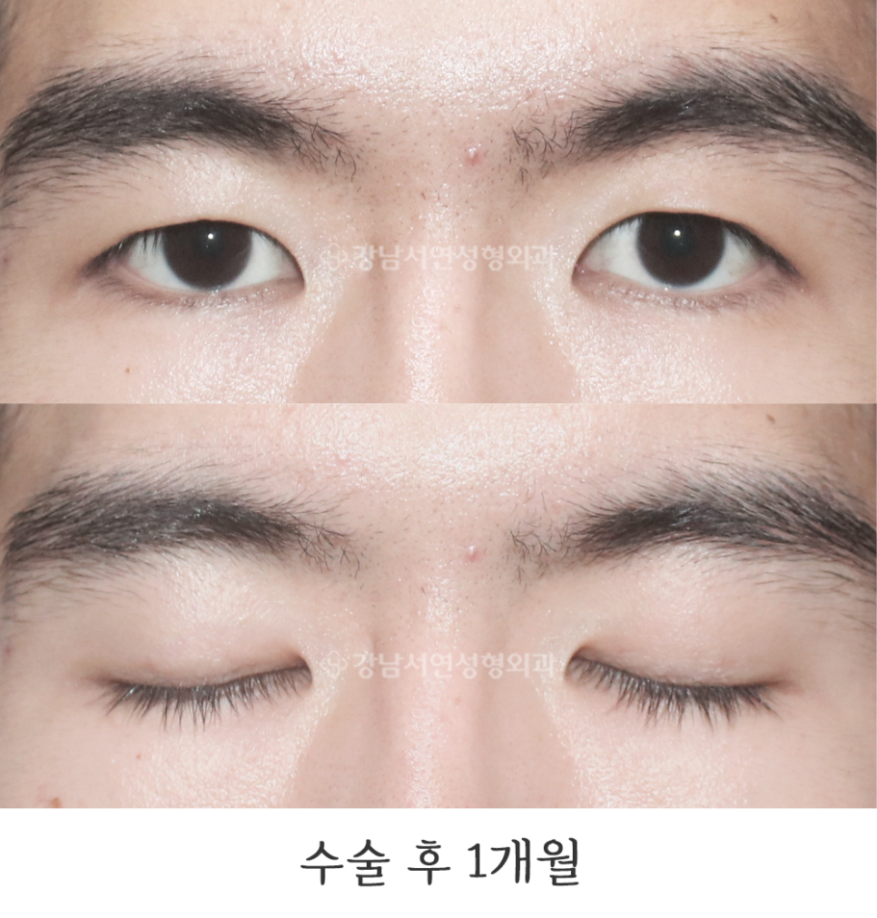 매몰실풀기 수술 후 사진
