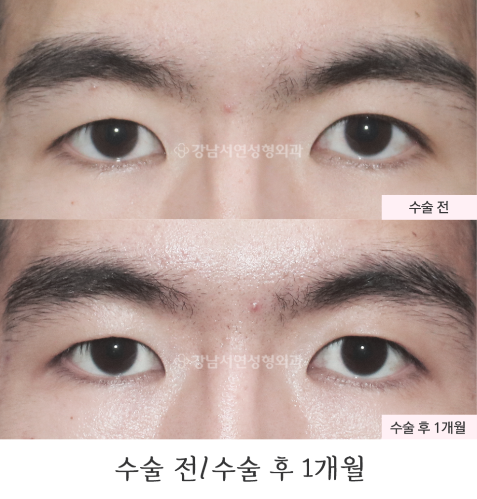 매몰실풀기 수술 전후 비교 사진