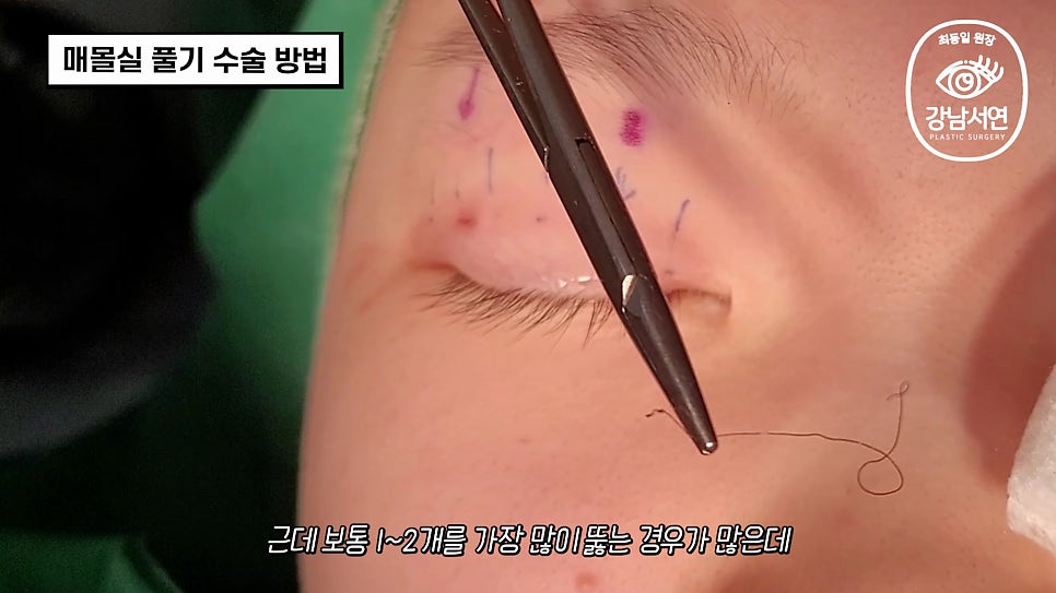 매몰실풀기 수술 장면