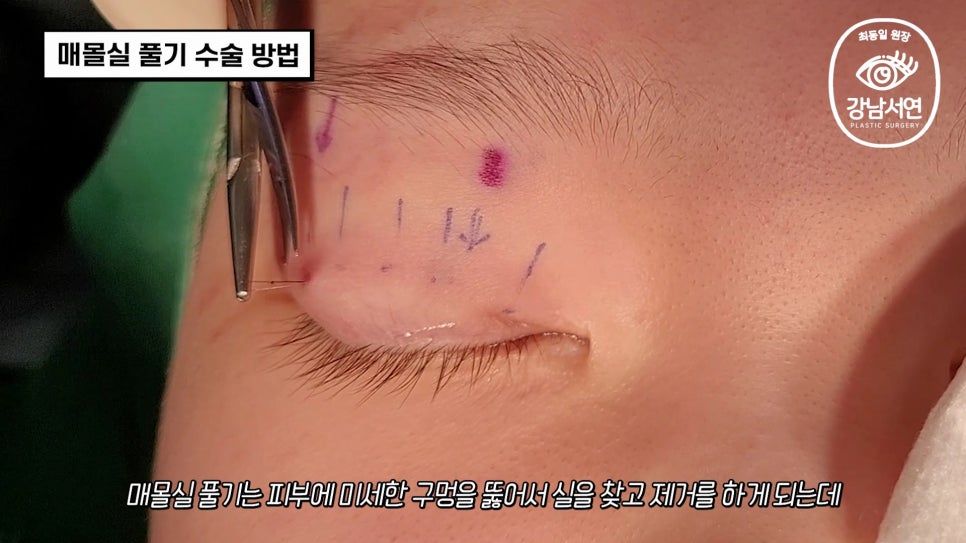 매몰실풀기 수술 장면