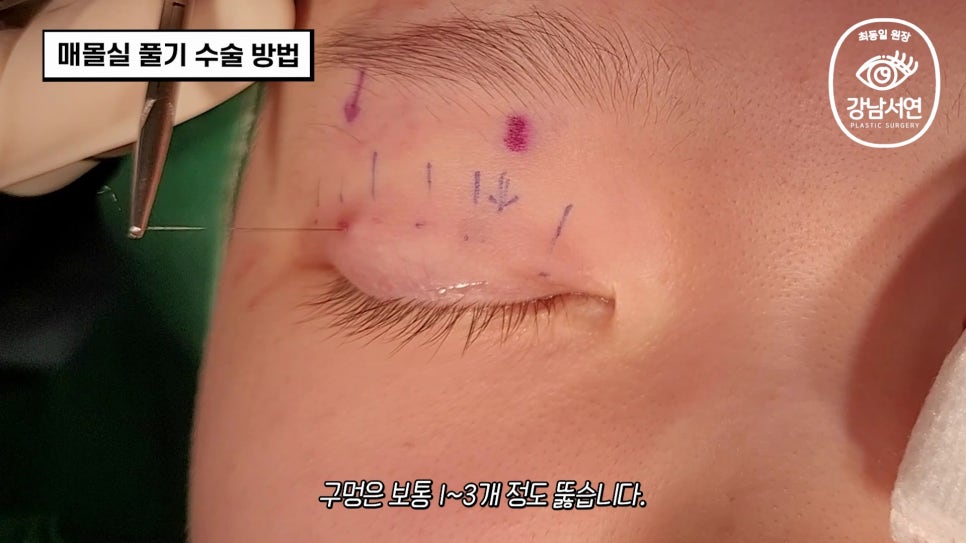 매몰실풀기 수술 장면