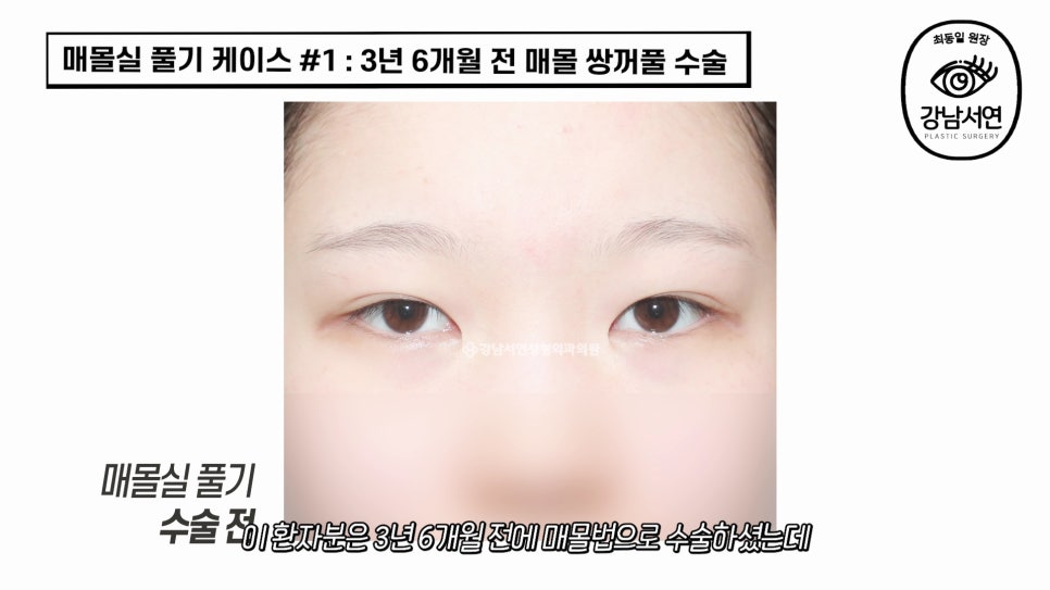 매몰실풀기 수술 전 사진