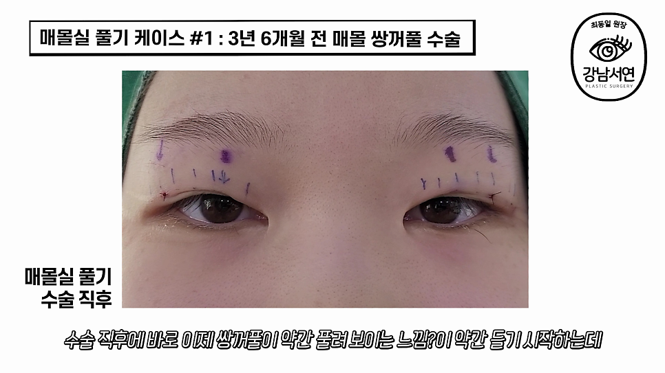 매몰실풀기 수술 후 사진