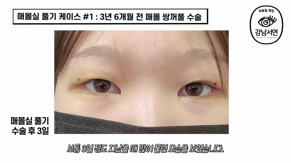 매몰실풀기 수술 후 사진