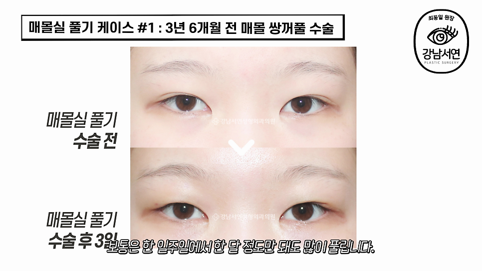 매몰실풀기 수술 후 사진