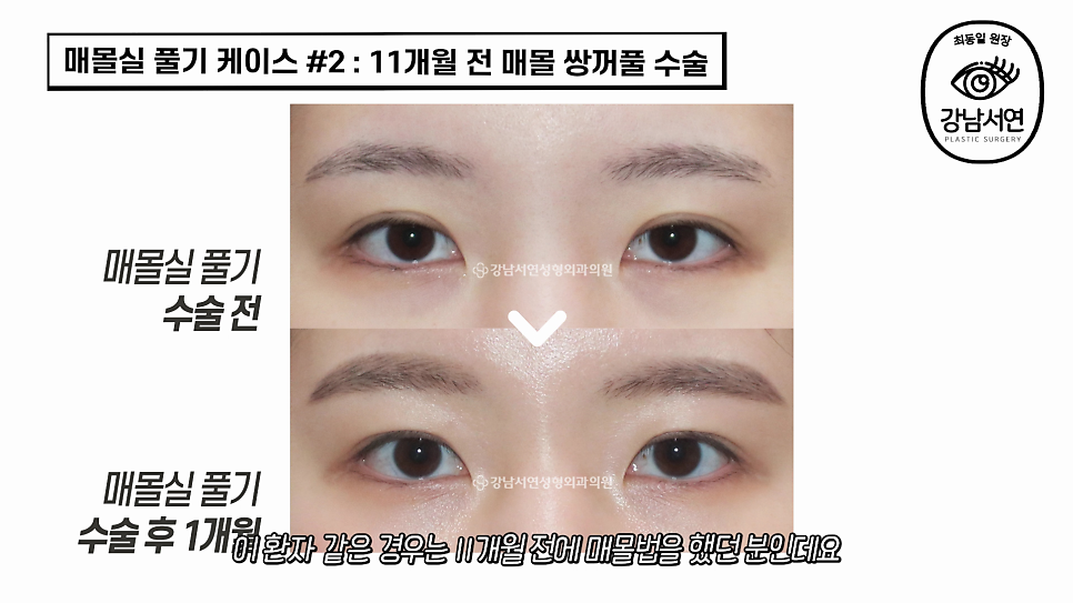 매몰실풀기 수술 전후 비교 사진