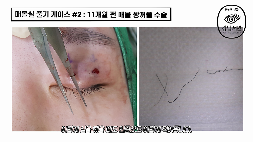 매몰실풀기 수술 장면