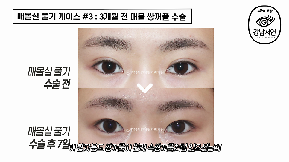 매몰실풀기 수술 전후 비교 사진