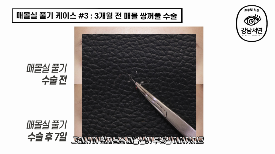 매몰실풀기 수술 장면