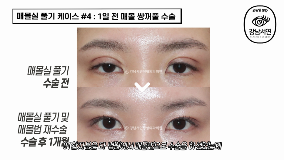 매몰실풀기 수술 전후 비교 사진
