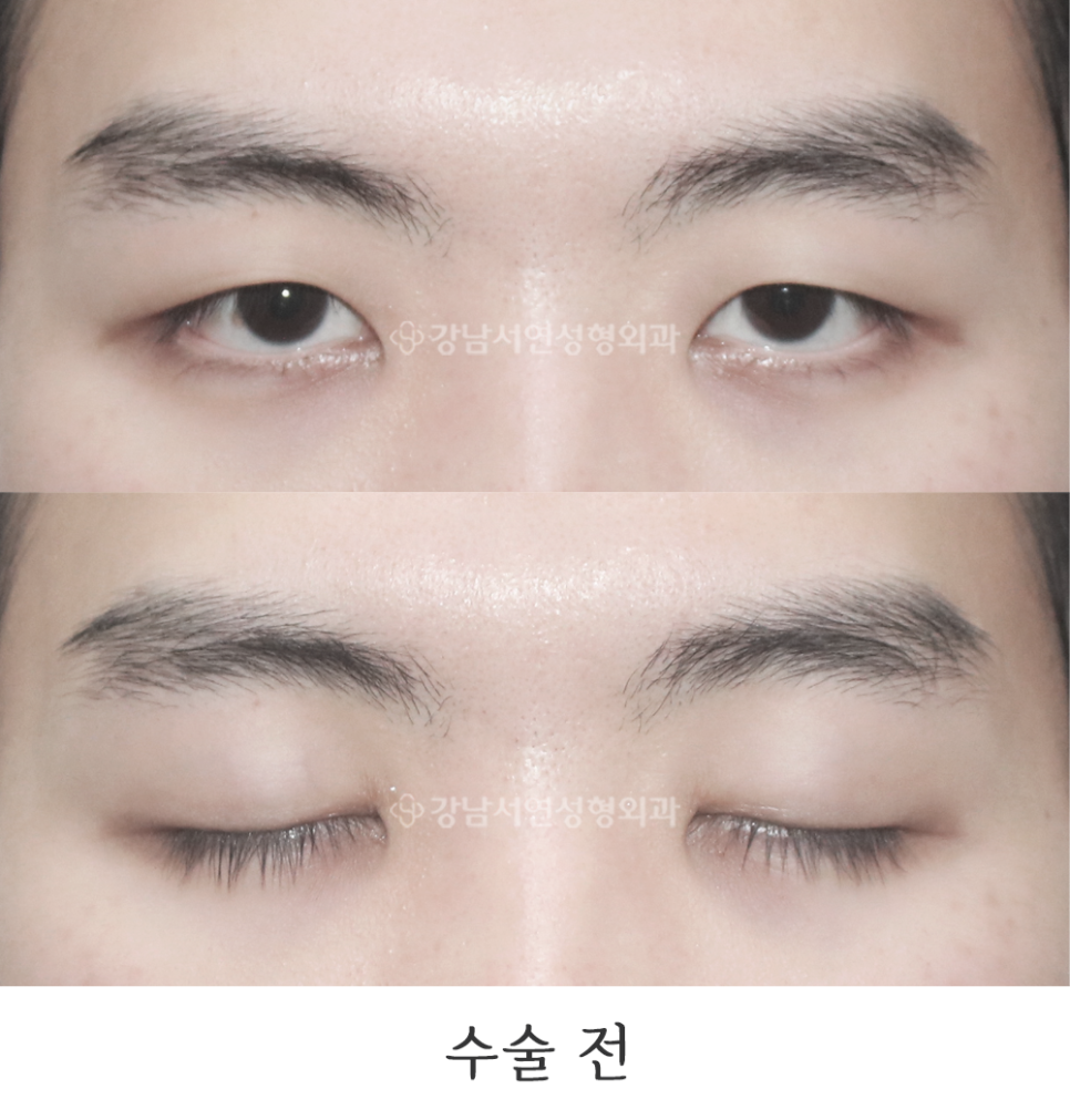 남자 눈성형 수술 전 사진