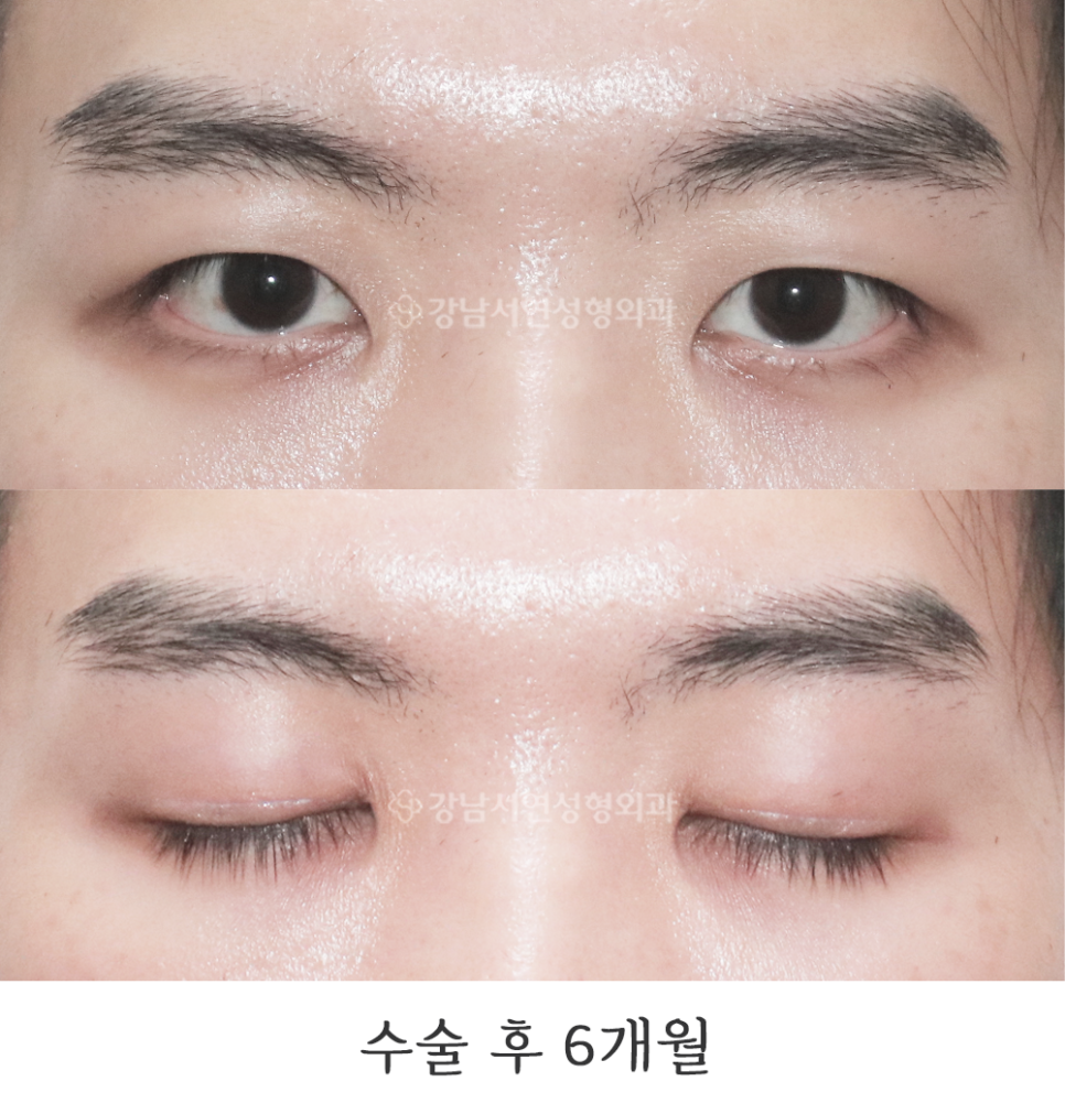 남자 눈성형 수술 후 사진