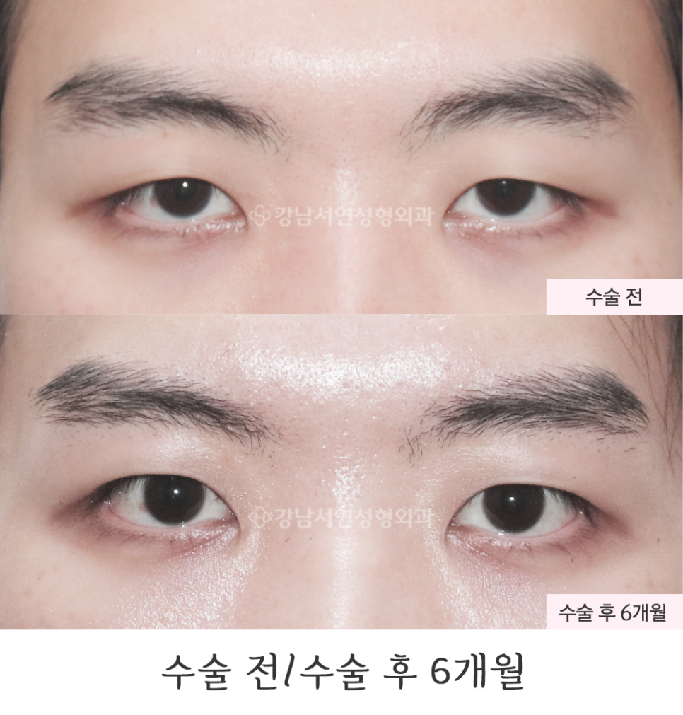 남자 눈성형 수술 전후 비교 사진