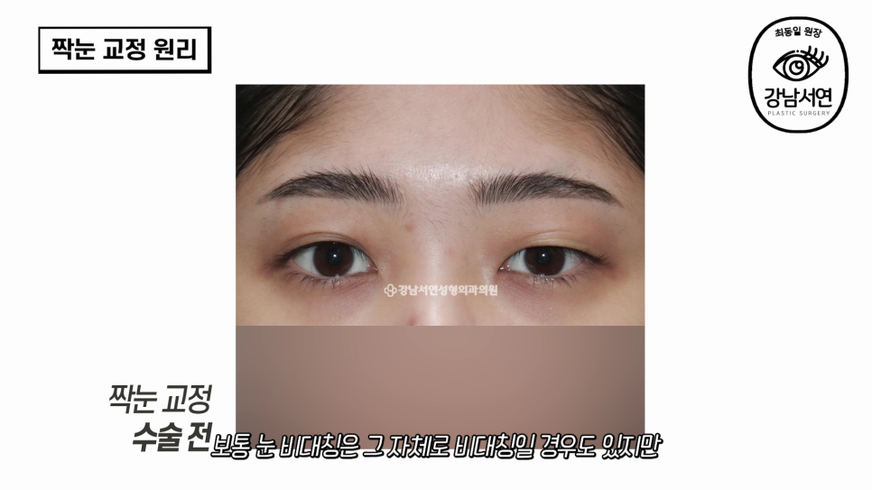 눈성형 수술 전 사진