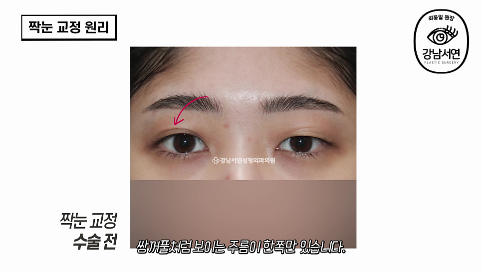 눈성형 수술 전 사진