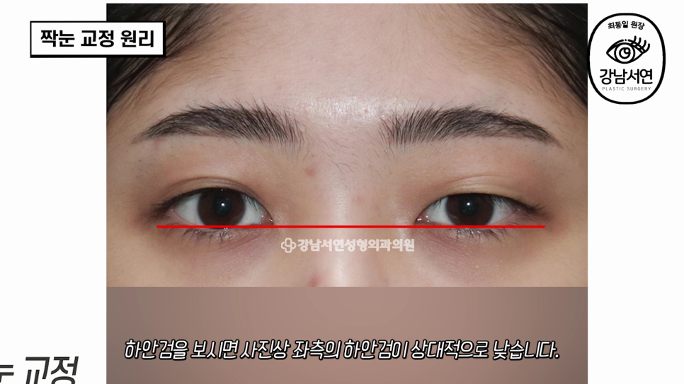 눈성형 수술 사례 눈 사진