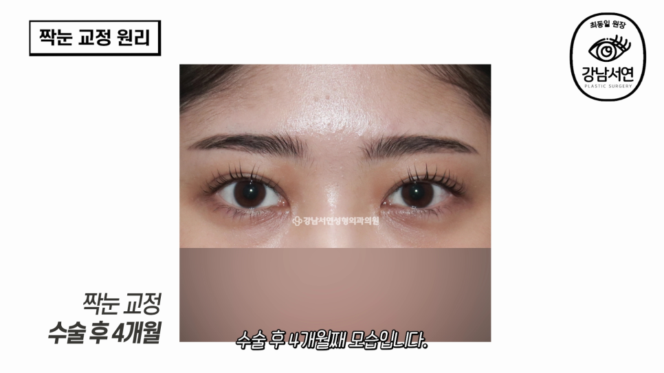 눈성형 수술 후 사진