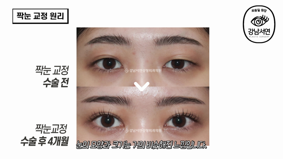 눈성형 수술 전후 비교 사진