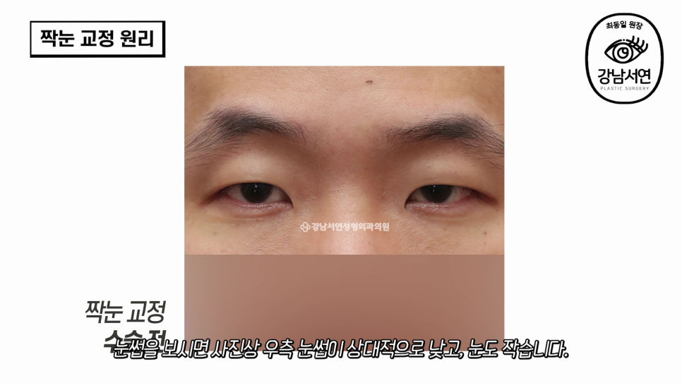눈성형 수술 사례 눈 사진
