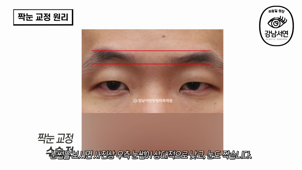 눈성형 수술 전 사진