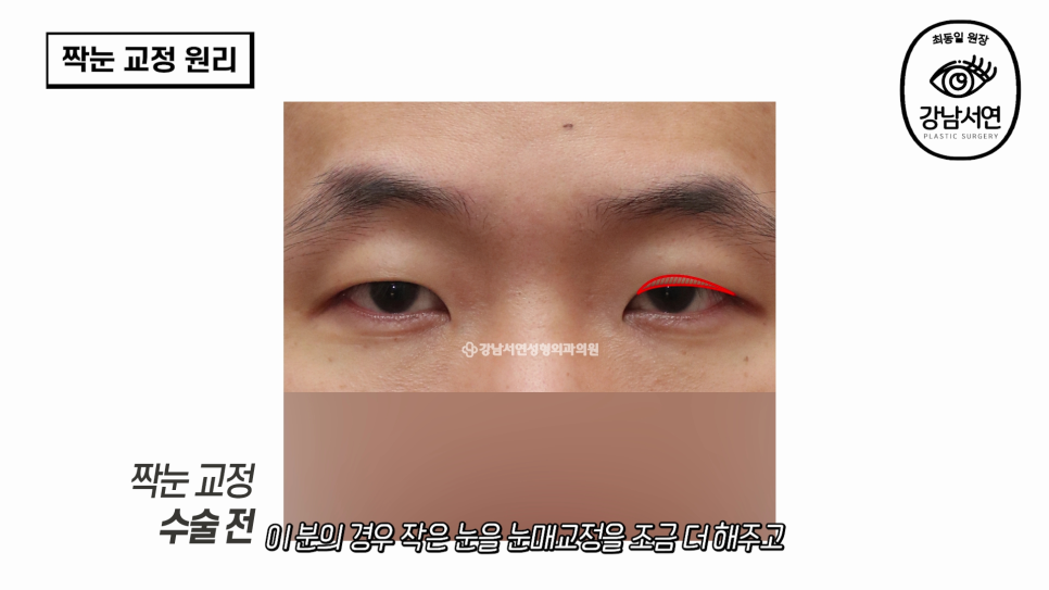 눈성형 수술 전 사진