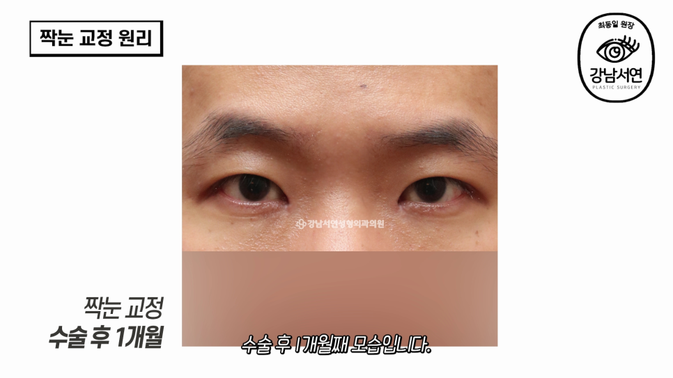 눈성형 수술 전 사진