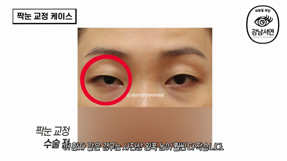 눈성형 수술 후 사진