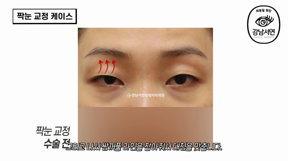 눈성형 수술 전 사진