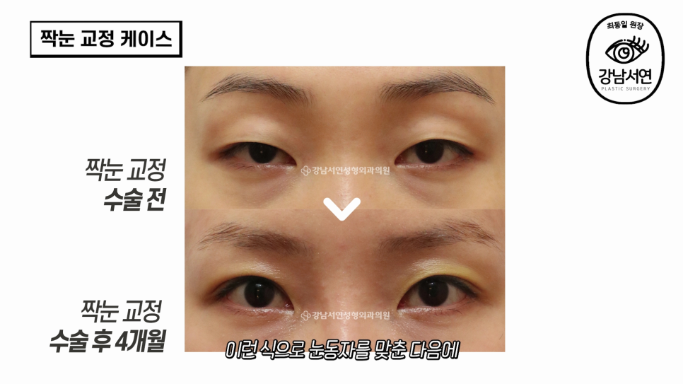 눈성형 수술 전 사진