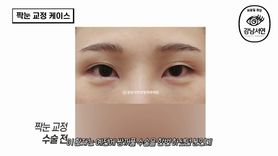 눈성형 수술 전후 비교 사진