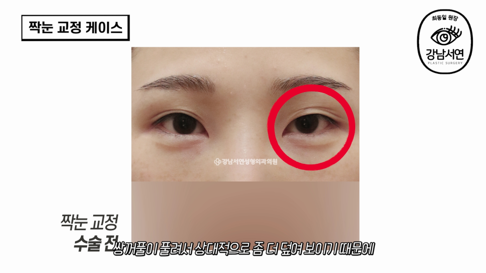 눈성형 수술 후 사진