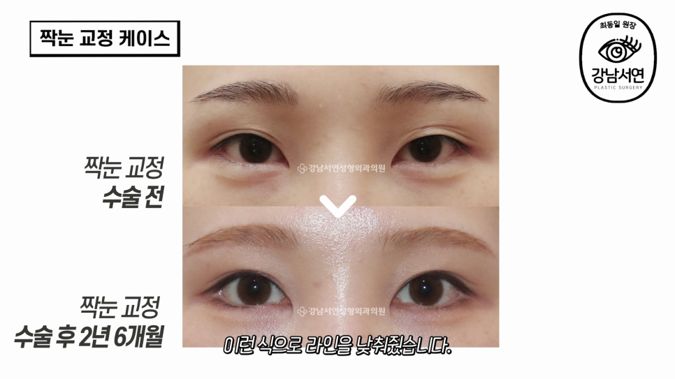 눈성형 수술 전 사진