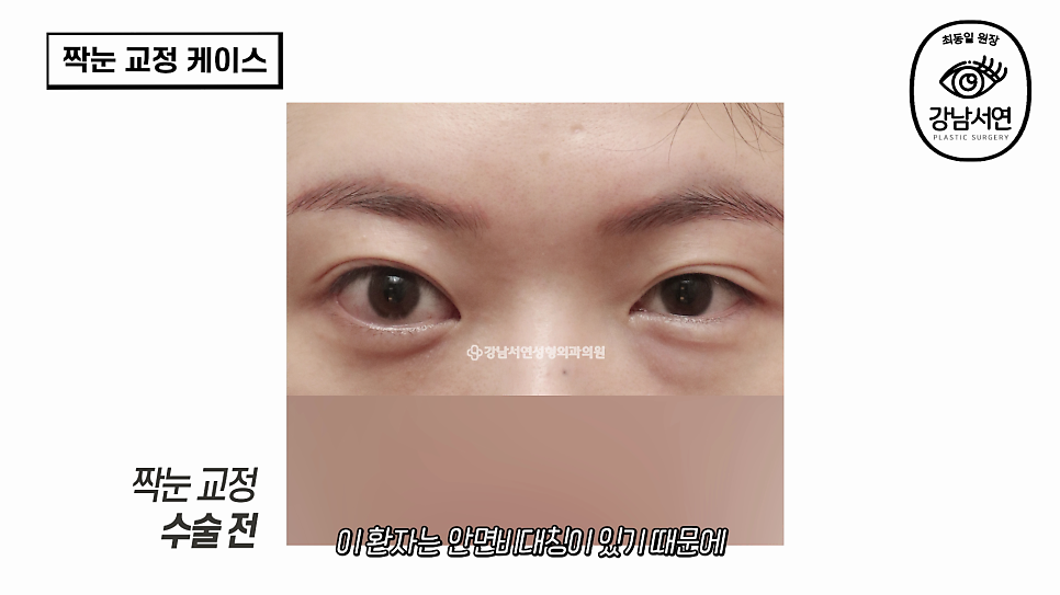 눈성형 수술 전 사진