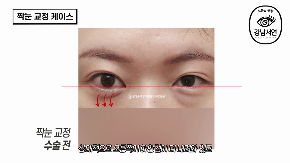 눈성형 수술 전후 비교 사진