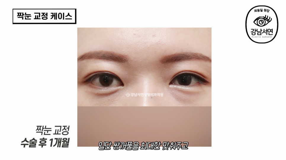 눈성형 수술 전 사진