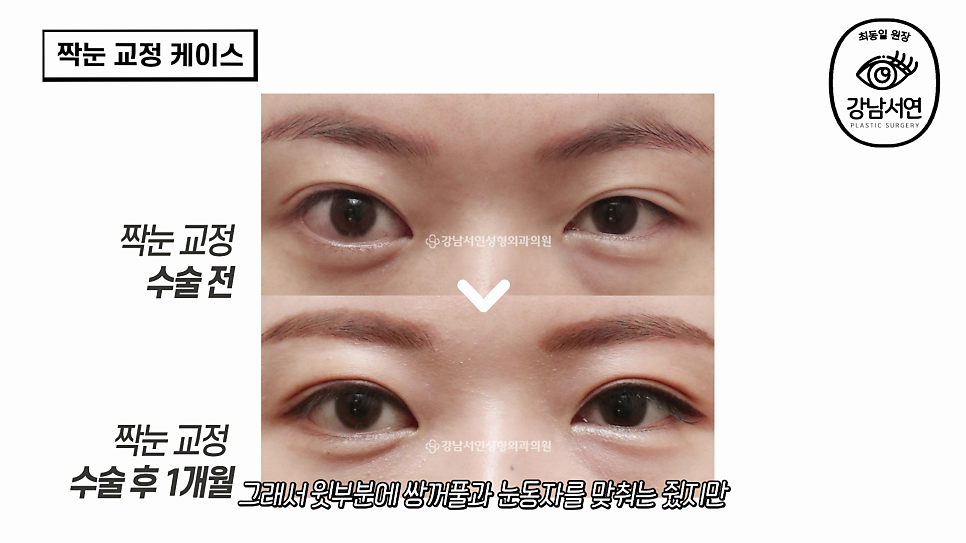 눈성형 수술 전 사진