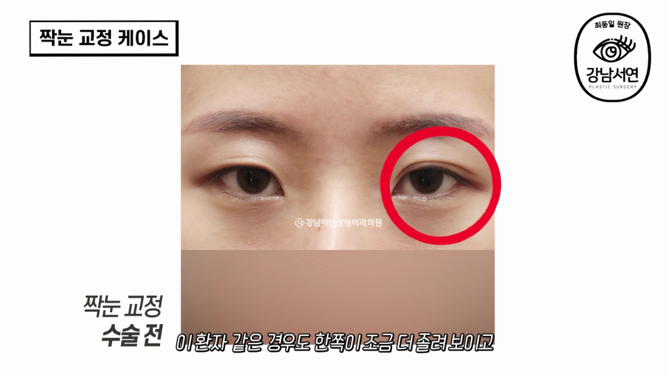 눈성형 수술 후 사진