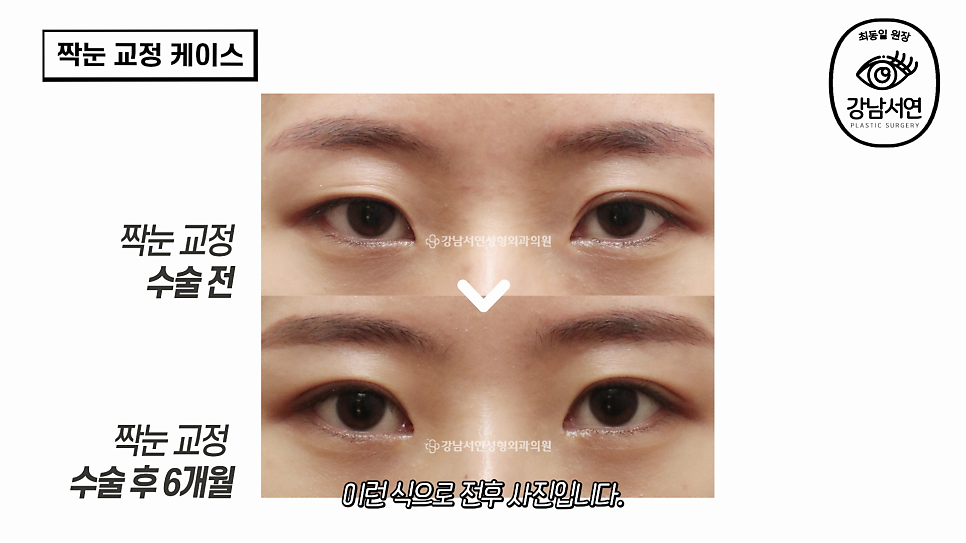 눈성형 수술 전후 비교 사진