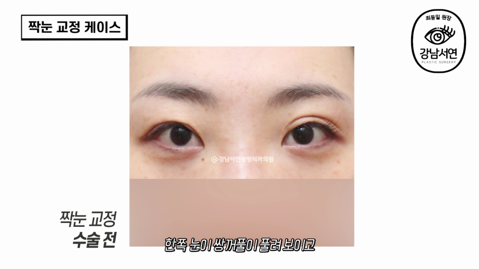 눈성형 수술 후 사진
