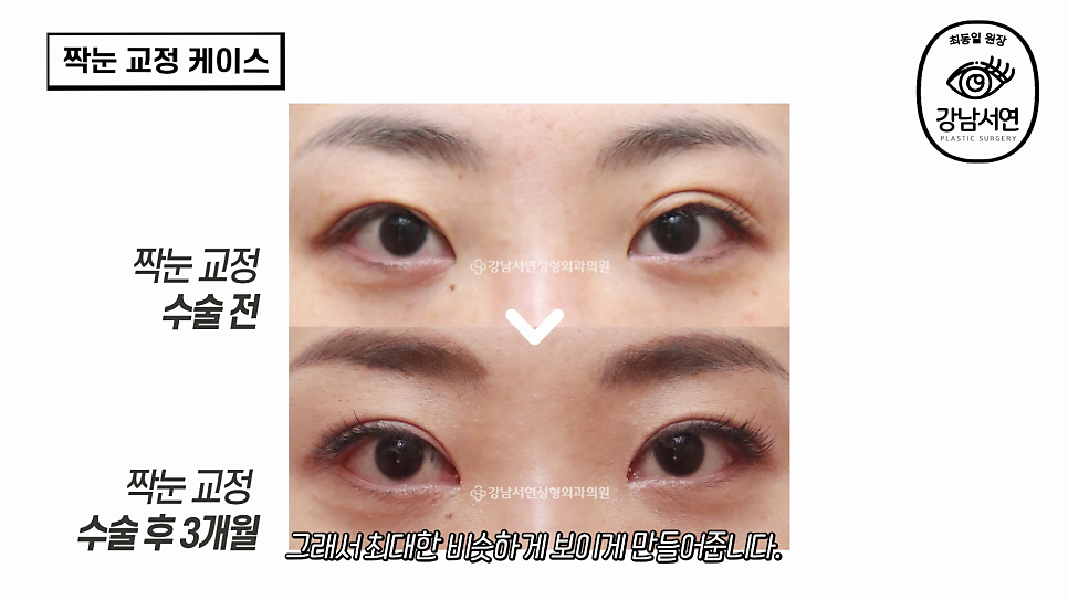 눈성형 수술 전 사진