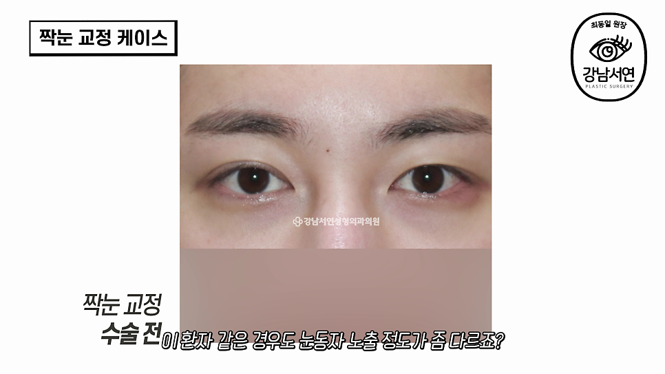눈성형 수술 전 사진