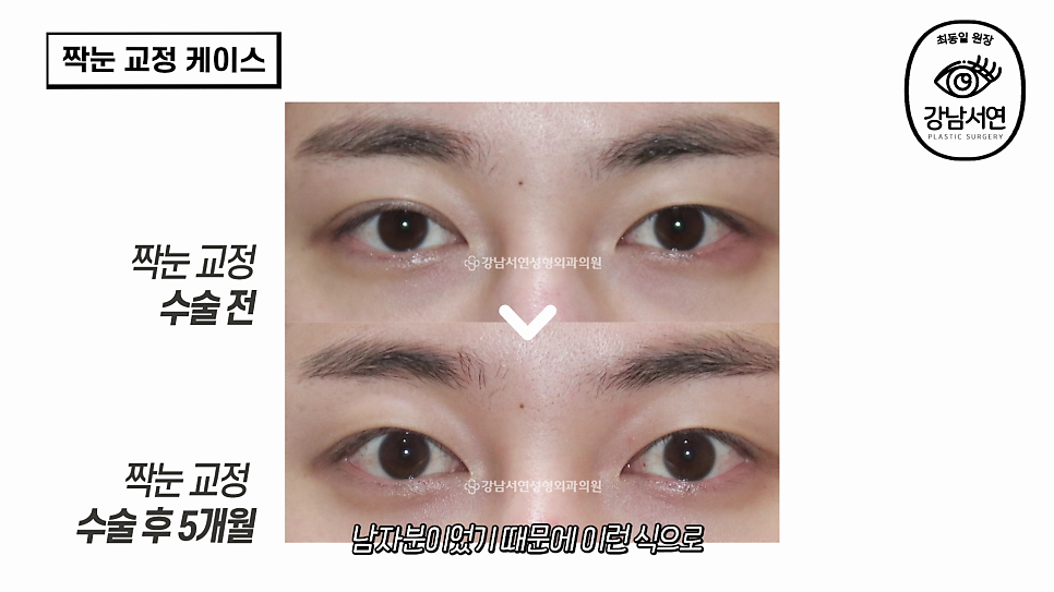 눈성형 수술 전후 비교 사진