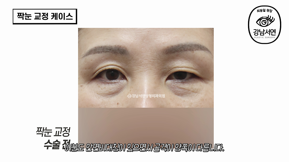 눈성형 수술 전 사진