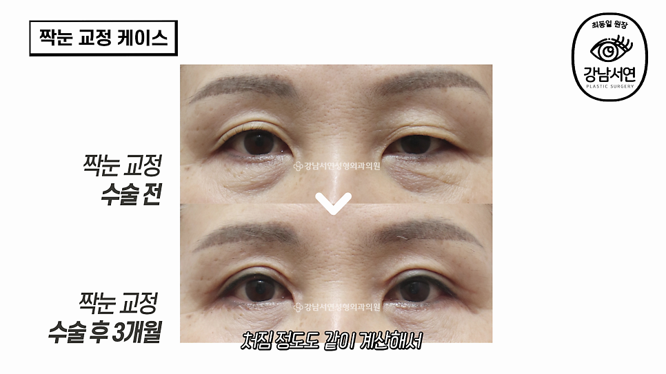 눈성형 수술 전후 비교 사진
