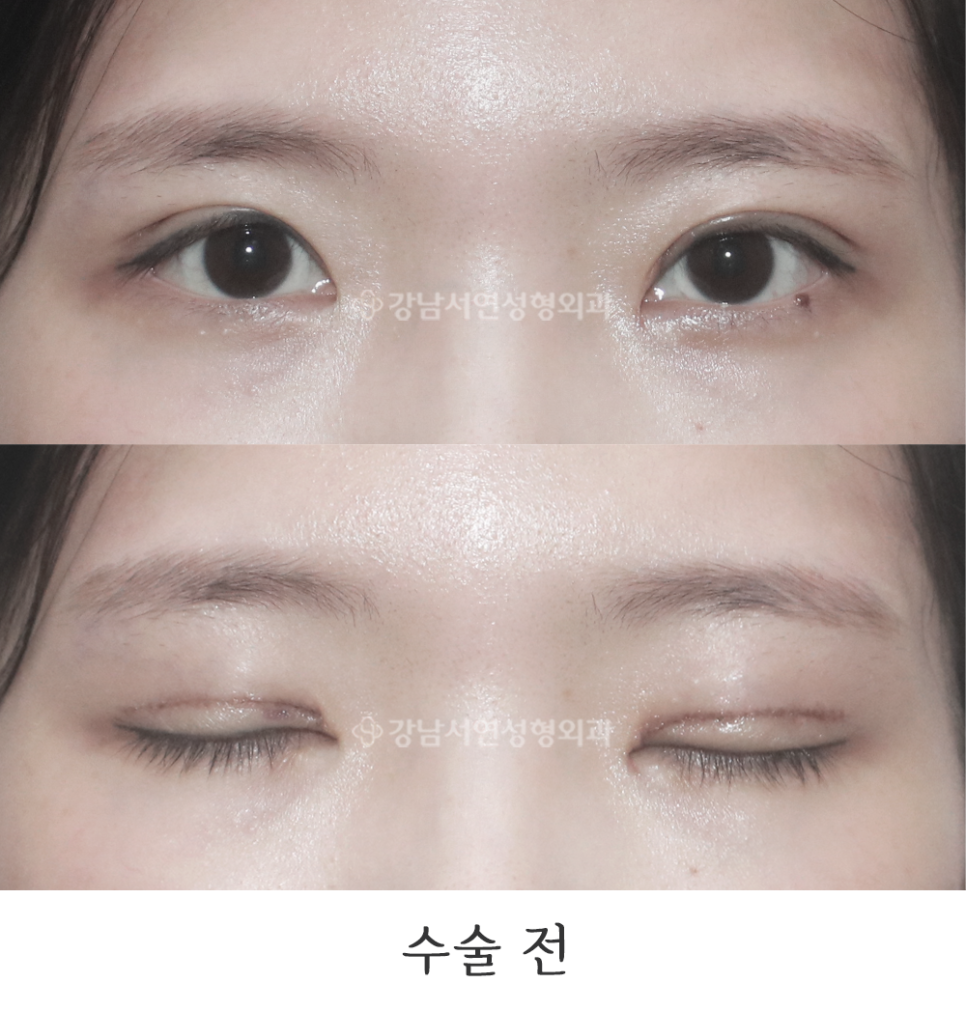 쌍꺼풀 조기재교정 수술 전 사진