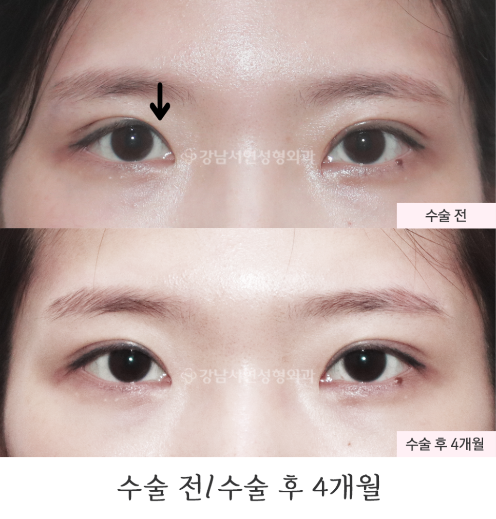 쌍꺼풀 조기재교정 수술 전후 비교 사진