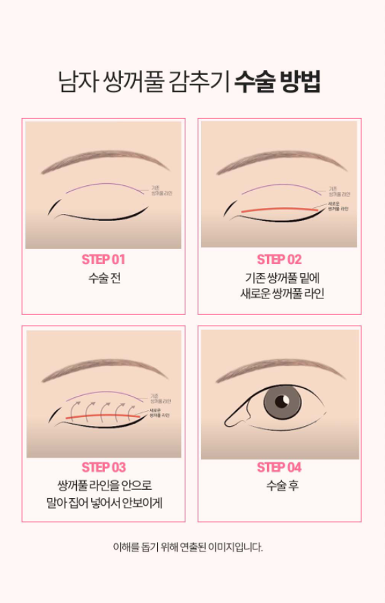 남자 눈성형 설명 도해