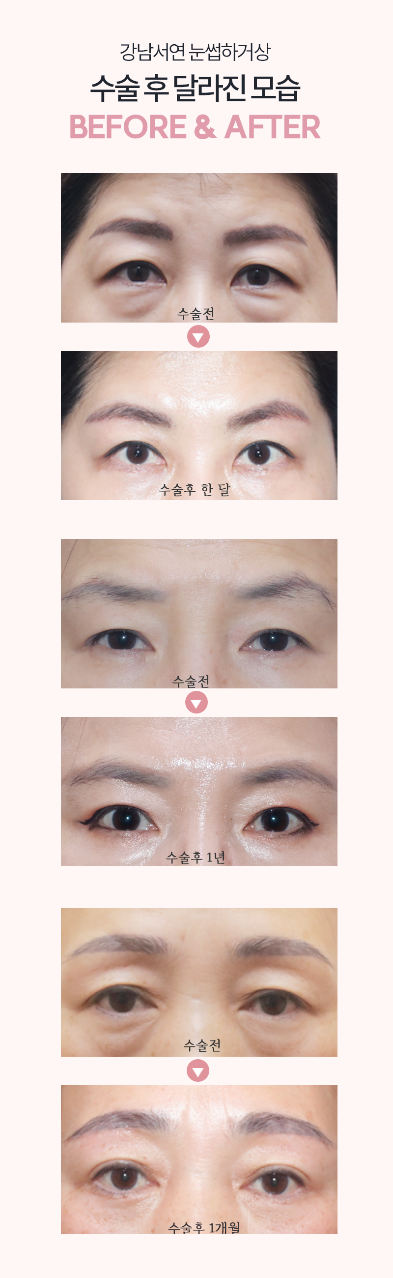 눈성형 수술 전후 비교 사진
