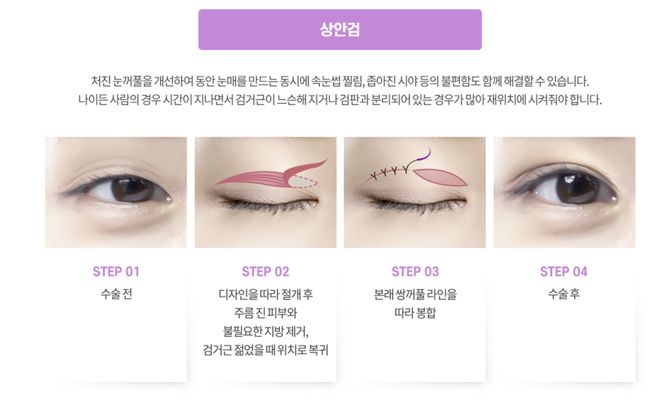 상안검성형 설명 도해
