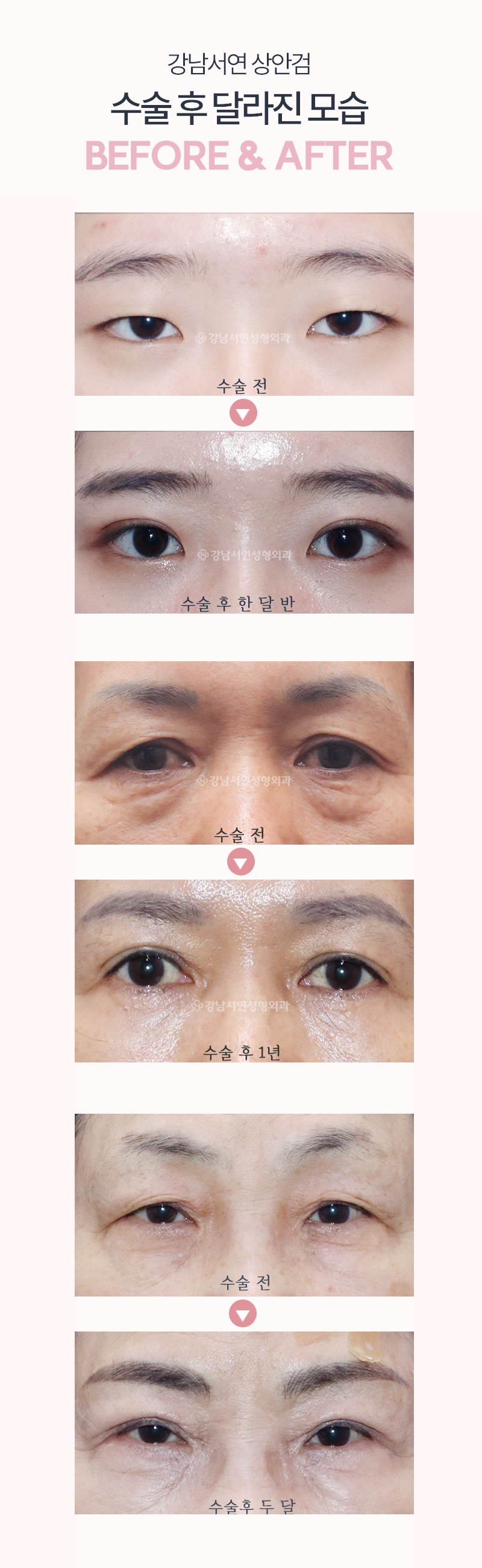 상안검성형 수술 전후 비교 사진